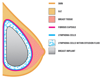 BIA implantat